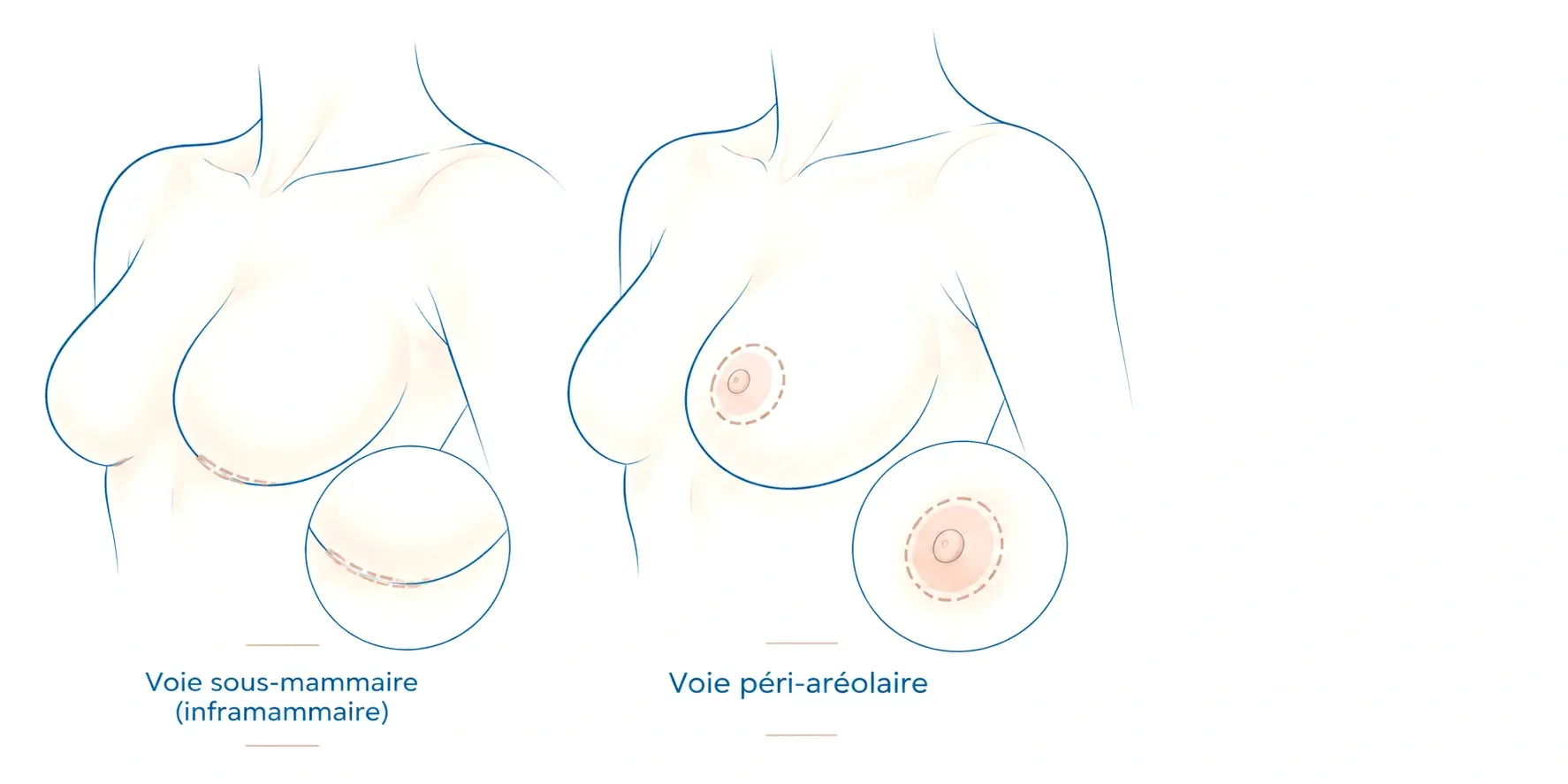 Schéma de deux voies d'abord d'une augmentation mammaire, avec un détail agrandi de chacune : la voie sous-mammaire (inframammaire), incision dans le sillon sous le sein, et la voie péri-aréolaire, incision à la limite de l'aréole.