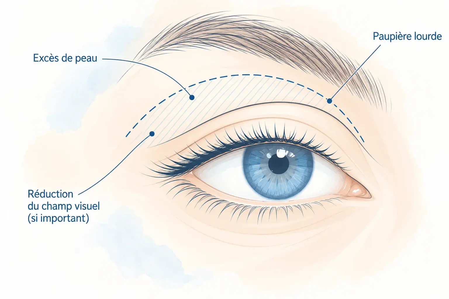 Illustration d'un œil ouvert montrant l'excès de peau de la paupière supérieure, une paupière lourde et la réduction du champ visuel lorsque l'excès est important.