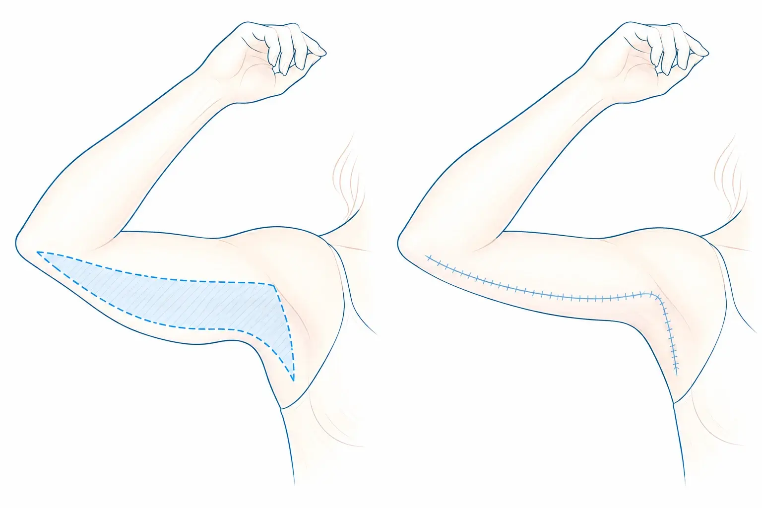 Schéma de la brachioplastie : à gauche, le bras levé avec la zone de peau à retirer, hachurée sur sa face interne, du coude jusqu'à l'aisselle ; à droite, la cicatrice qui en résulte, le long de la face interne du bras jusqu'au creux de l'aisselle.
