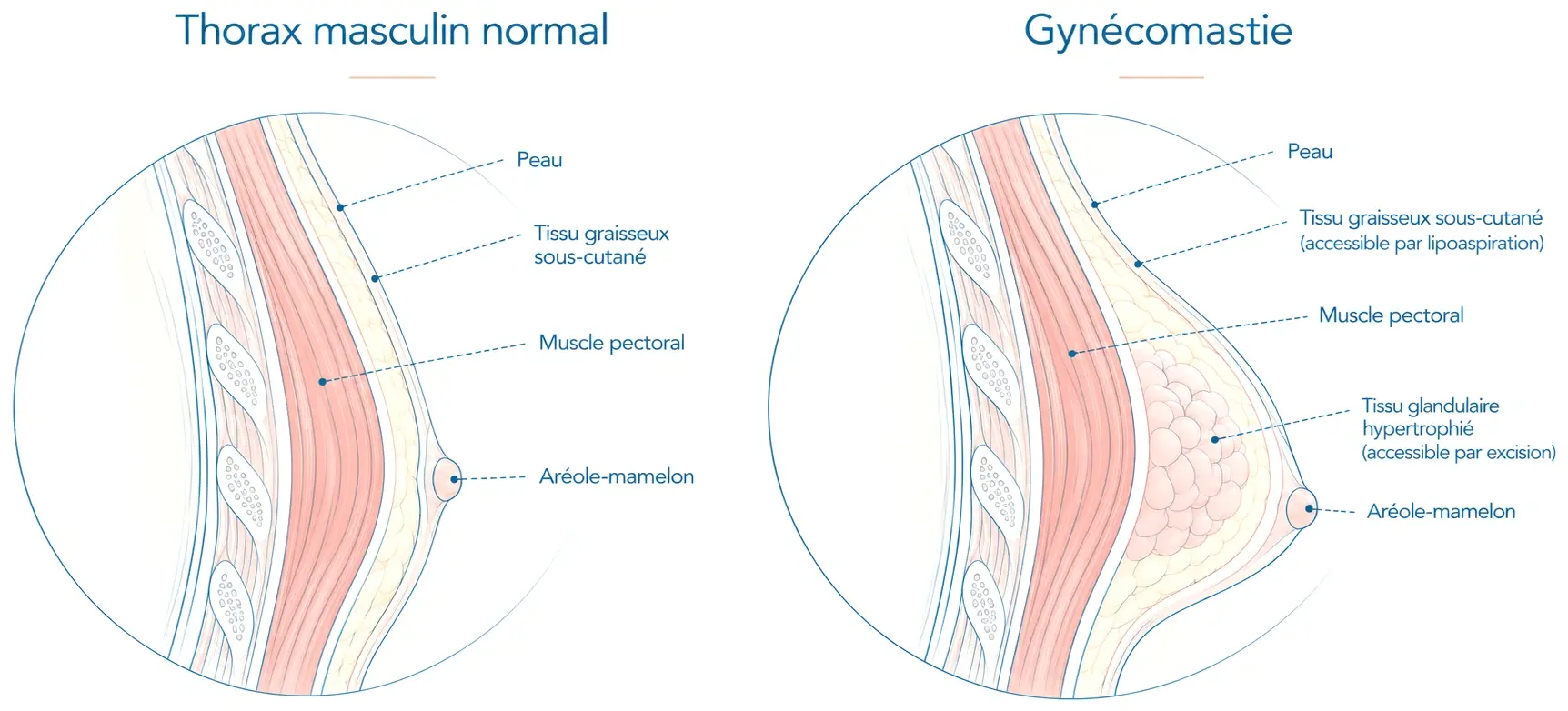 Schéma comparant en coupe un thorax masculin normal et une gynécomastie : peau, tissu graisseux sous-cutané, muscle pectoral et aréole-mamelon ; dans la gynécomastie, le tissu glandulaire hypertrophié, accessible par excision, et le tissu graisseux sous-cutané, accessible par lipoaspiration.