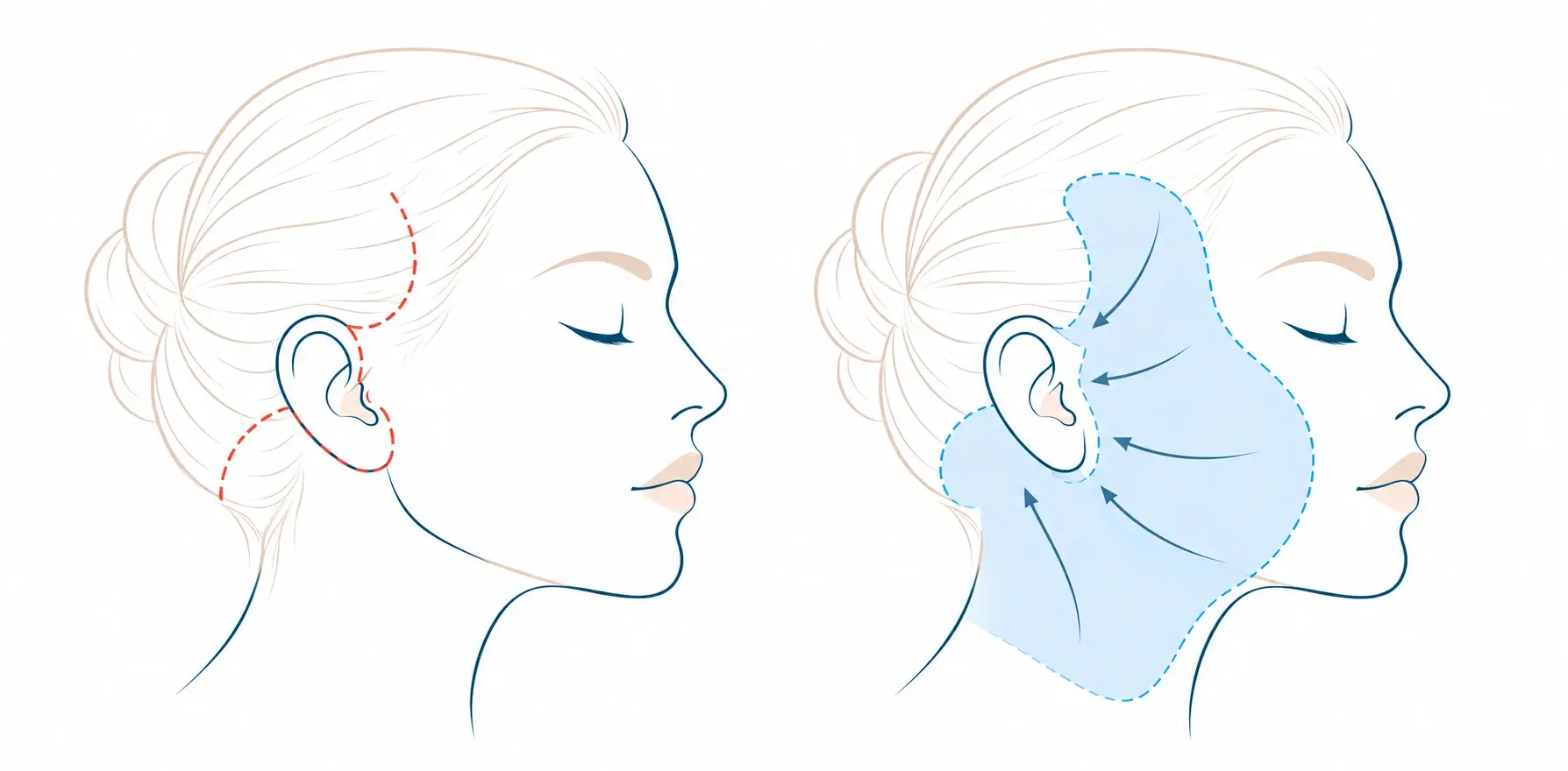 Schéma des cicatrices et de la zone de décollement d'un lifting facial et cervico-facial : à gauche, le tracé des incisions dans la région temporale, autour de l'oreille puis en arrière dans la chevelure ; à droite, la zone de décollement de la tempe, de la joue, de la ligne mandibulaire et d'une partie du cou, avec la direction de la remise en tension vers l'oreille.