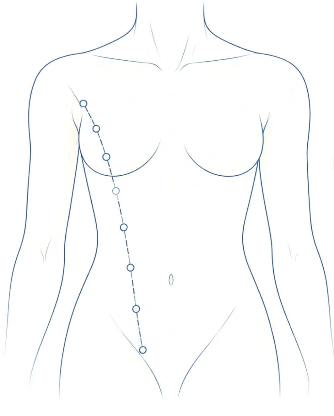 Silhouette de face montrant, en pointillés, la ligne mammaire embryonnaire qui descend de l'aisselle à l'aine en passant par le sein, jalonnée de cercles indiquant les emplacements possibles d'un mamelon surnuméraire.