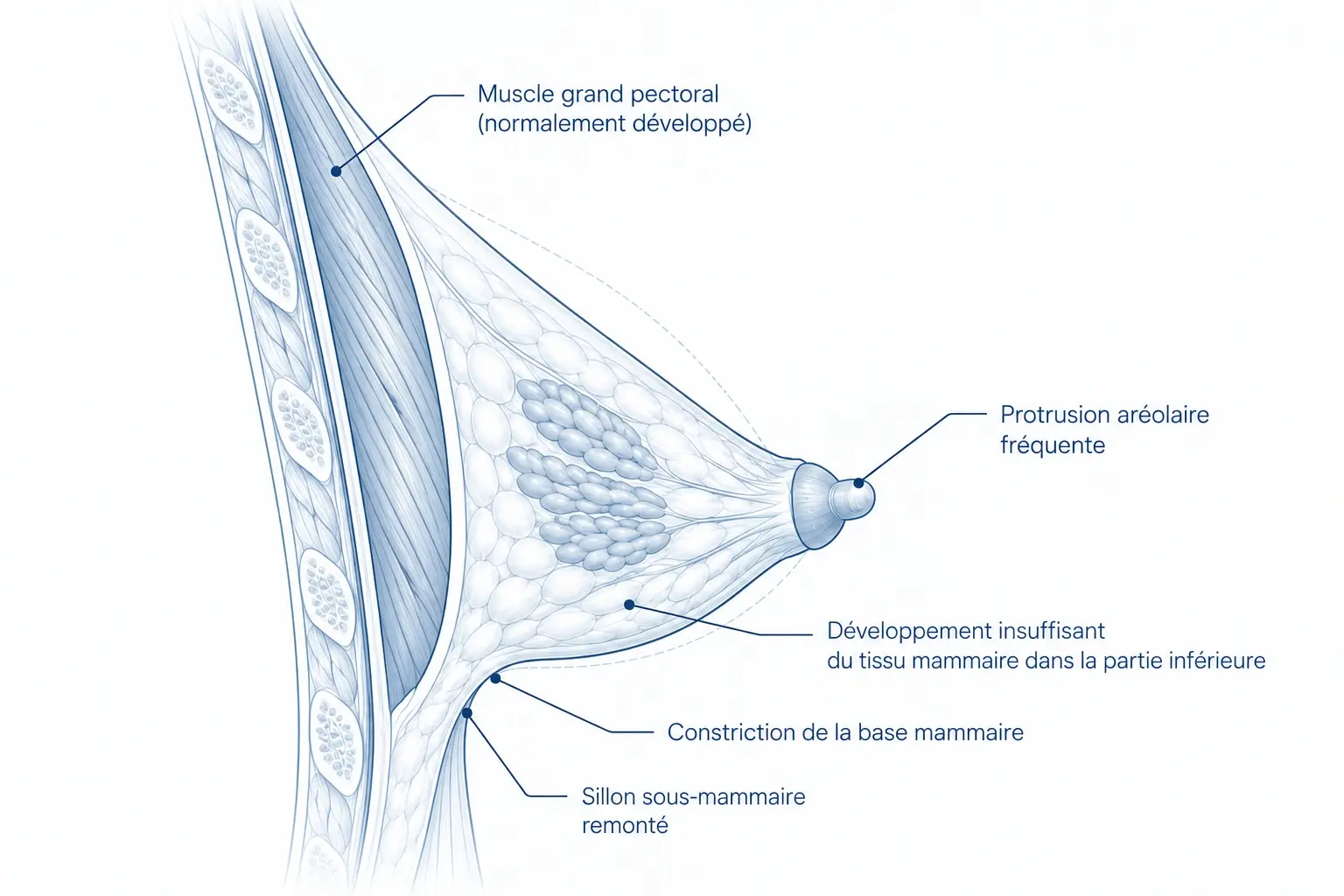 Coupe de profil d'un sein tubéreux, annotée : muscle grand pectoral normalement développé, protrusion aréolaire fréquente, développement insuffisant du tissu mammaire dans la partie inférieure, constriction de la base mammaire et sillon sous-mammaire remonté.