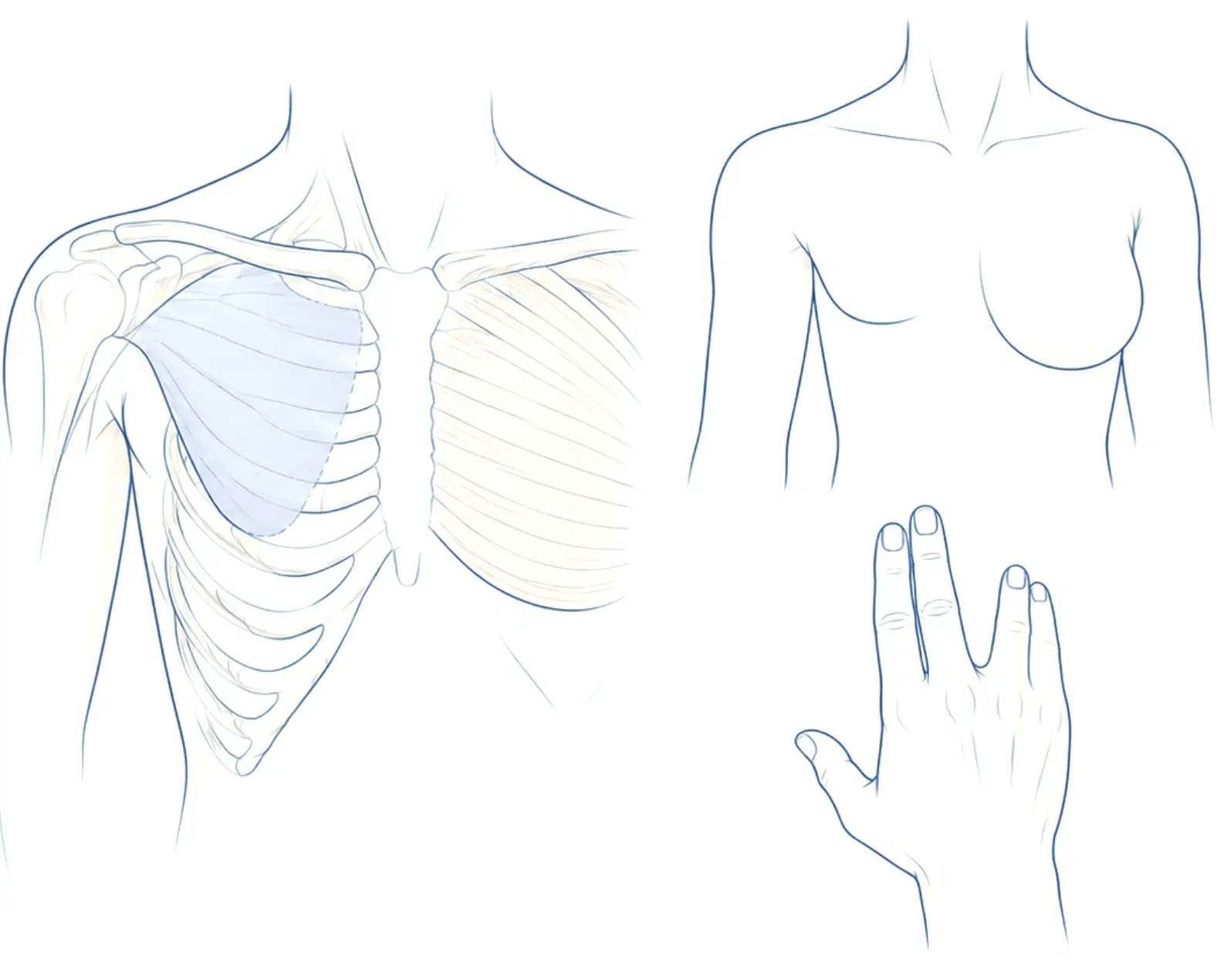 Syndrome de Poland : à gauche, thorax montrant d'un côté l'absence partielle du muscle grand pectoral (zone bleutée) ; à droite, buste aux seins asymétriques, le sein du côté atteint moins développé, et main présentant une anomalie des doigts.