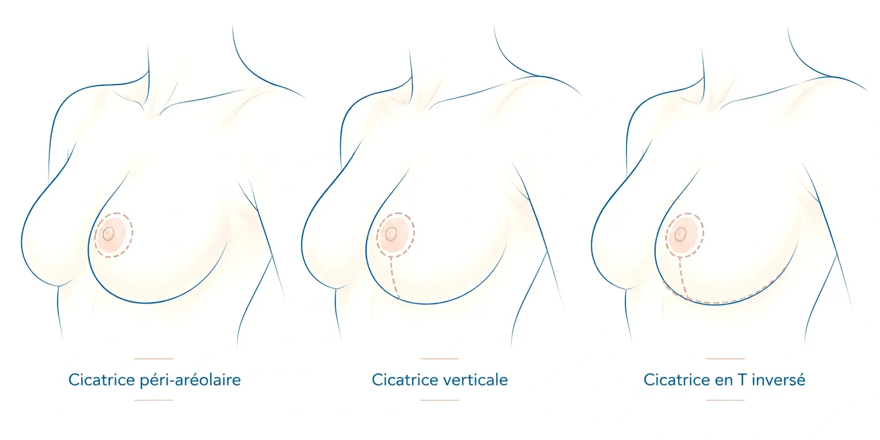 Schéma comparatif des trois types de cicatrices d'une mastopexie : péri-aréolaire, autour de l'aréole ; verticale, autour de l'aréole et jusqu'au sillon sous-mammaire ; en T inversé, avec en plus une cicatrice dans le sillon sous-mammaire.